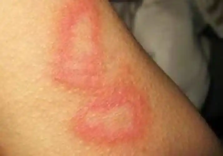 人的上身的放射性皮炎图片