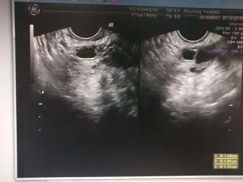 阴道超声监测卵泡分享