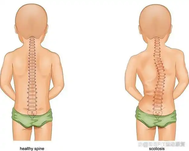 背部肩胛骨左右有不对称的突出3. 腰部左右不对称4.