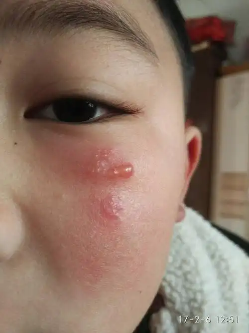你好,请问大家,儿童脸上长这种水泡用什么药膏擦效果好?急!