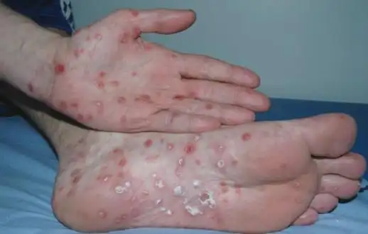 二期梅毒:最常见的表现是全身性,脱屑性斑丘疹,皮疹约 1cm 大小,颜色