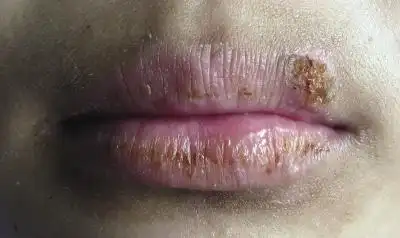 皮肤性病科图谱黏膜疾病剥脱性唇炎