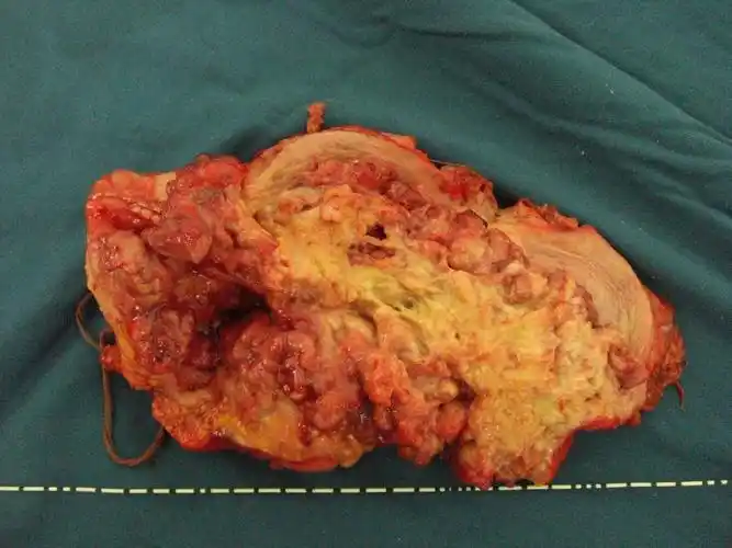 病例讨论一例膀胱癌的诊治