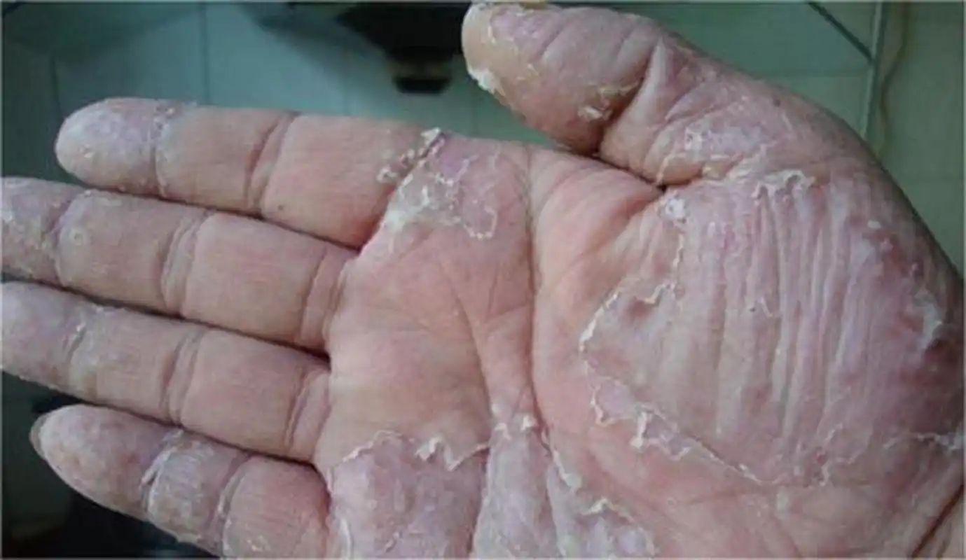 一般发病部位在于指间,手掌侧方皮肤为主,足癣是由于皮肤真菌感染足部