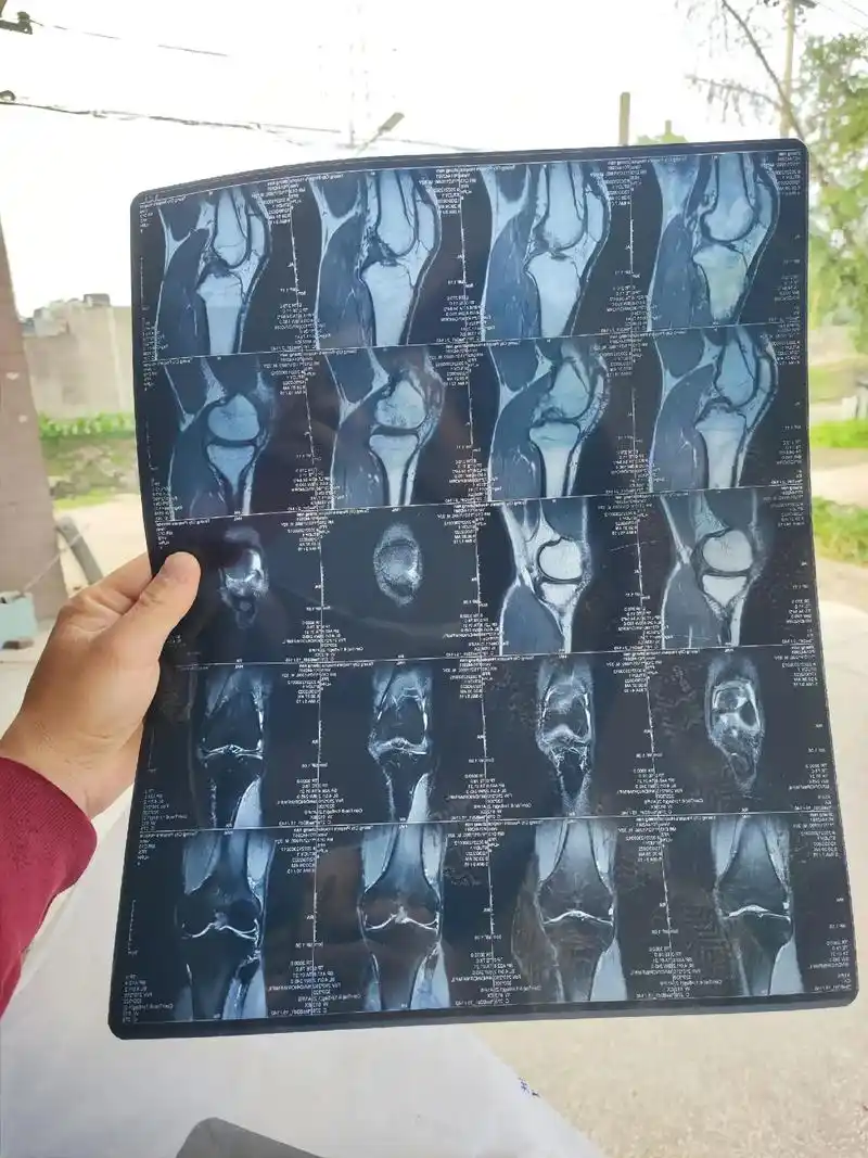 髌下脂肪垫炎.庸医啊  说没事开了瓶氨糖就完事了  身上的痛 - 抖音