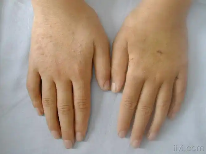 小孩手背毛囊角化症