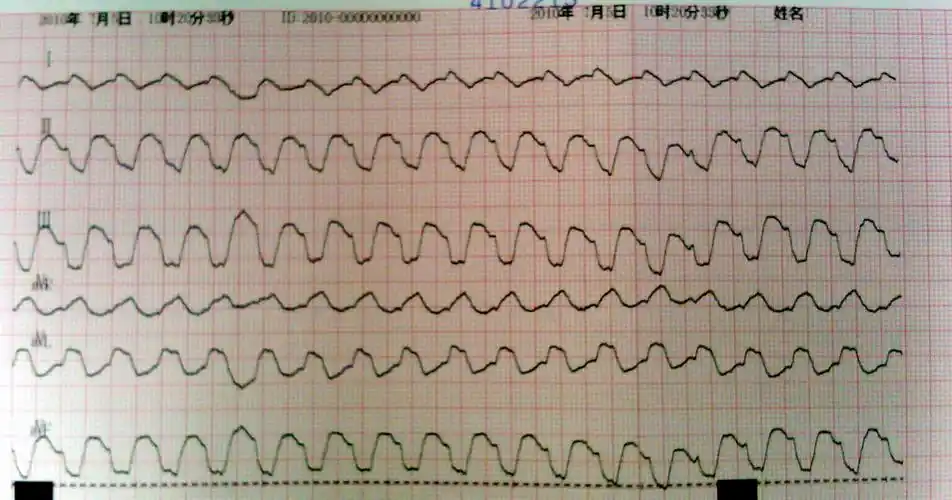 讨论-1例高钾血症心电图改变