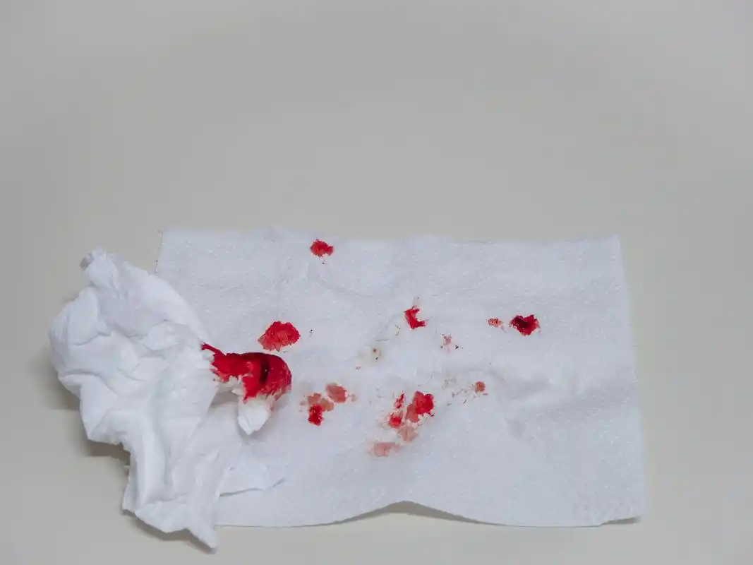 结核菌可侵袭肺部组织,导致肺部感染,使咳嗽时出现带血痰液.