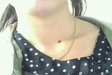 脖子痣相图解大全 位置不同含义不同