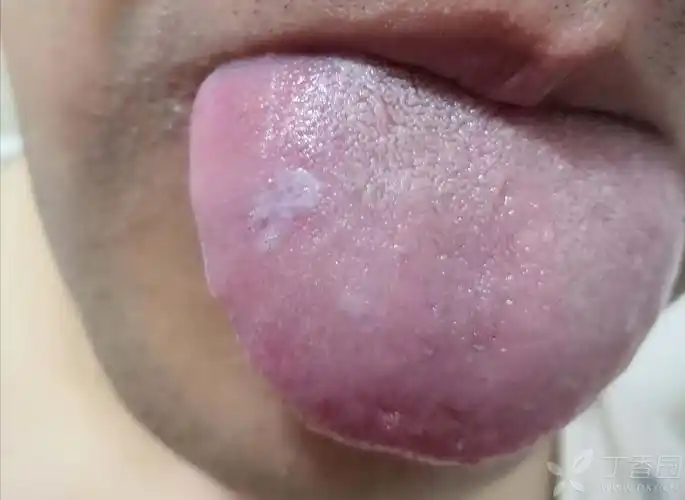 看看我舌头白斑是什么问题?谢谢