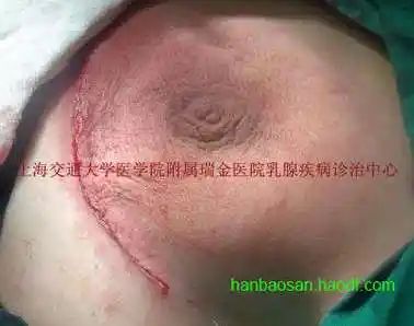 乳腺良性肿瘤:触目惊心的乳腺巨大纤维瘤!附图片 - 好大夫在线