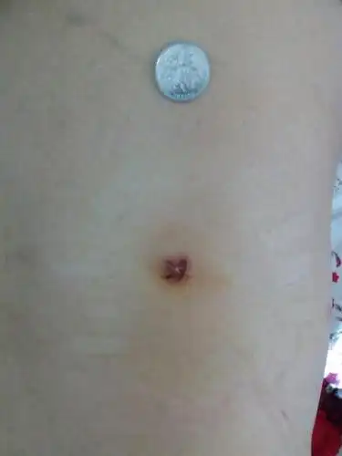 肾结石微创手术伤口渗水,可以上云南白药吗