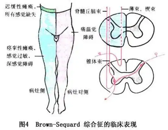 颈膨大水平以上病变出现四肢上运动神经元瘫,颈膨大病变出现双上肢下