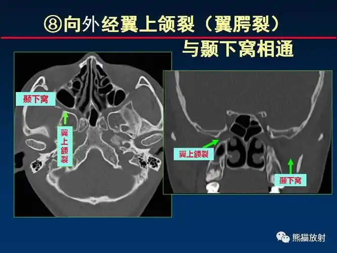 【柳澄讲坛】"翼腭窝解剖"--msct