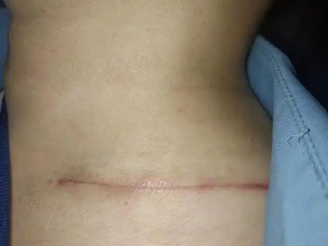 甲状腺术后45天,伤口的疤痕恢复有点慢,白天困晚上睡不着,急了