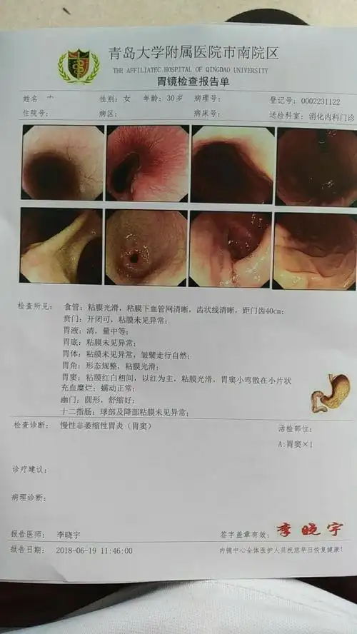 记一次胃镜检查