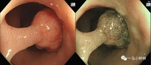 结肠息肉图谱