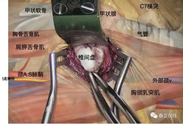 颈椎前路减压融合术|颈椎_新浪财经_新浪网