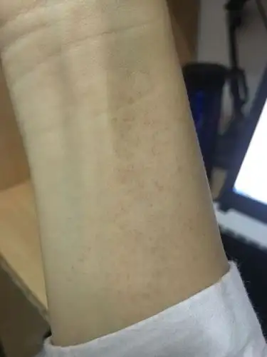 手臂内测突然好多 黑斑点长出来