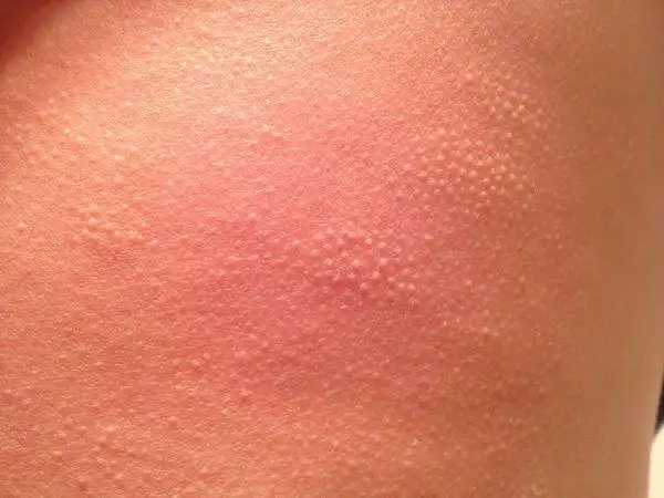 追问 是不是粟丘疹啊 回答 就是疹子一类的,没有看医生,宝宝自己就好