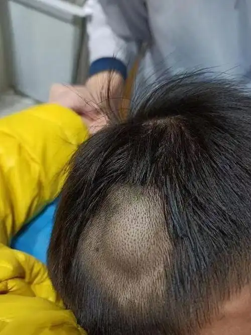 这个患儿是一个头部的血管瘤,治疗了一个疗程,肿块明_圈子-新氧美容