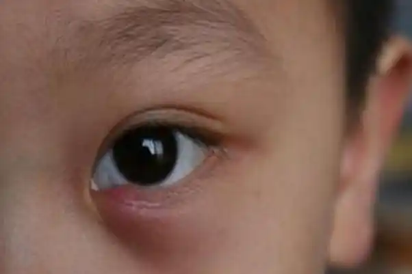 宝宝眼睛长了麦粒肿怎么办 宝宝长麦粒肿的原因