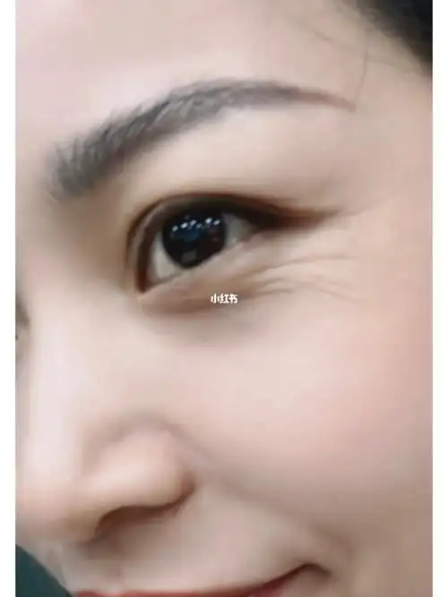 鱼尾纹前后对比第一天