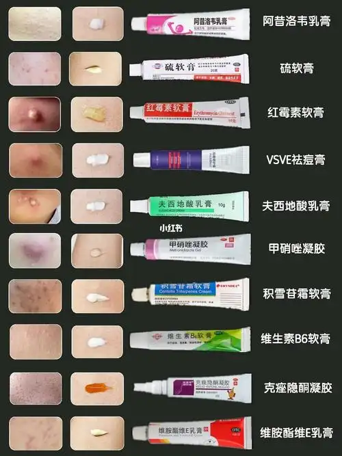 学生党秋冬常备平价祛痘膏痘痘肌变奶油肌