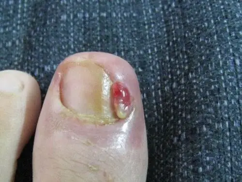 无甲沟炎,往肉内长等症状,请那位神 啥是甲沟炎 得了甲沟炎怎么才能治