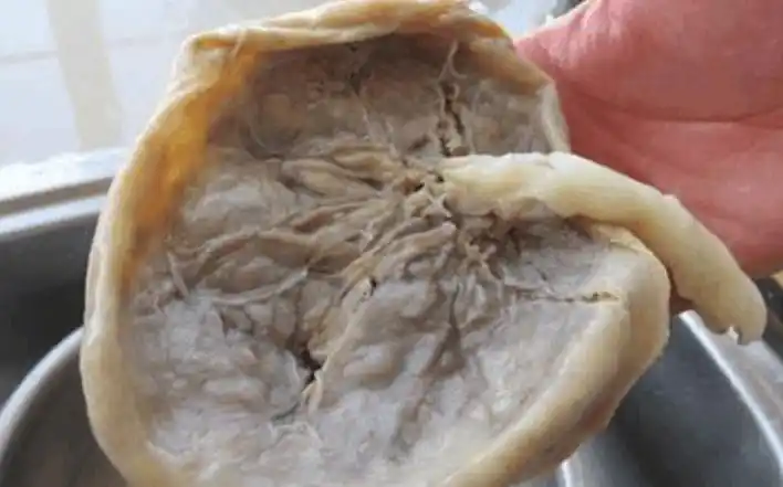 胎盘这样的处理, 对孩子好, 很多宝妈都不知道