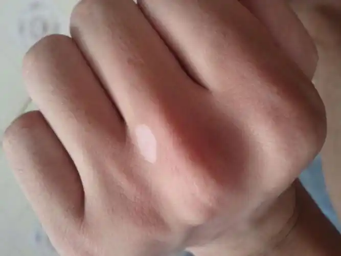 手上有个白斑,要怎么样才能治好?