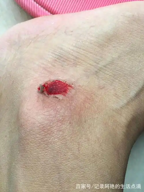 脚上擦伤的还是很疼,过几天应该就好