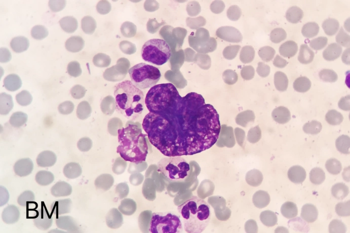 骨髓细胞学检查:有核细胞增生明显活跃,粒红两系比例及形态大致正常