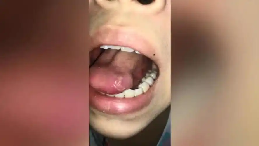 带女儿去补牙,舌头被割破缝了8针!门诊:将负责到底