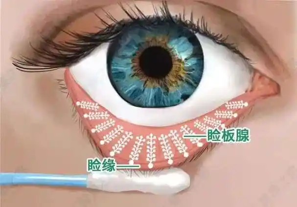 什么是睑板腺功能障碍如何缓解