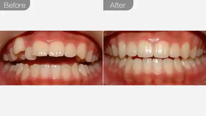 牙齿矫正-隐形矫正效果图,案例前后对比照片