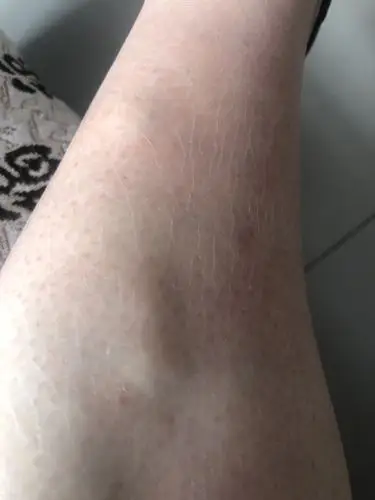 请问皮下这个是囊肿吗?