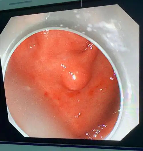 我院消化科独立完成我市首例胃肿瘤剥离术