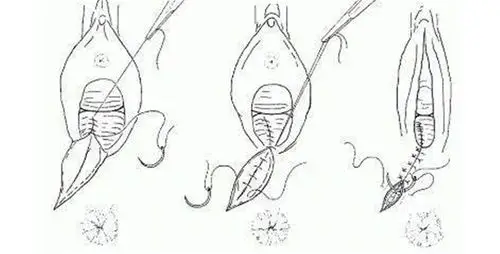 生产会阴撕裂缝合图片_有来医生