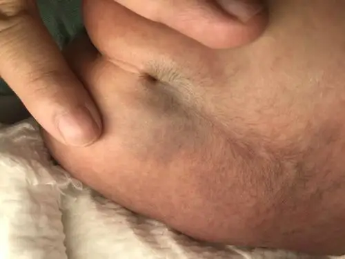 新生儿骶尾小窝与隐性脊柱裂_隐性脊柱裂_隐性脊柱裂介绍 - 好大夫