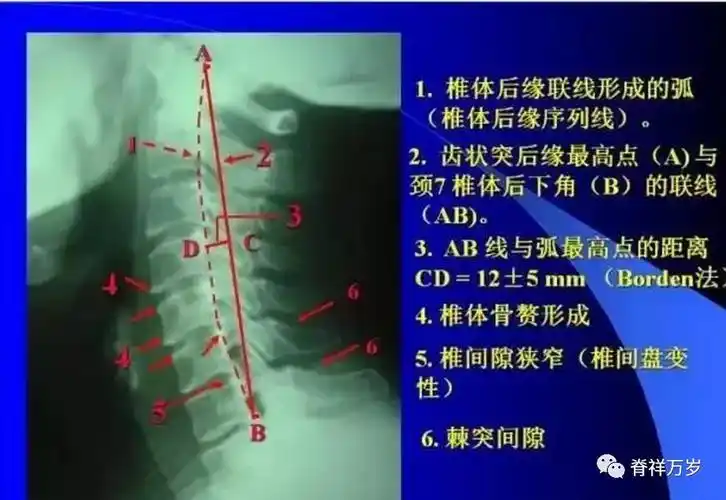 颈椎病x光片解析