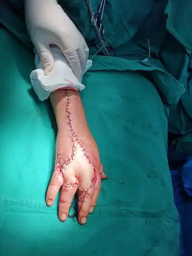 昌乐县人民医院手足,创伤显微外科游离皮瓣技术稳步发展