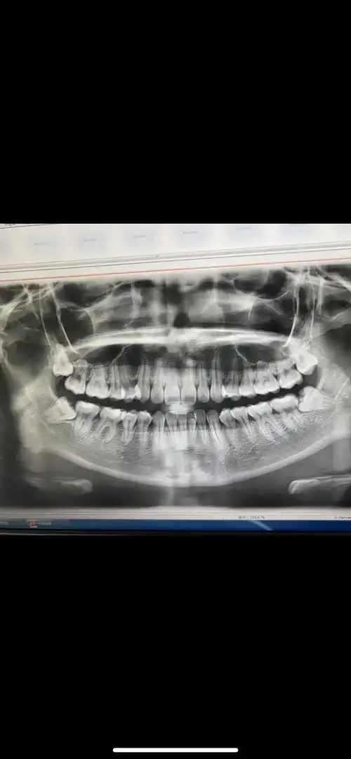 拔掉两颗智齿医生说还剩一个最难的