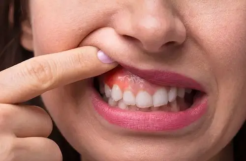 牙龈发炎肿痛,该怎么办?口腔医生和你聊聊