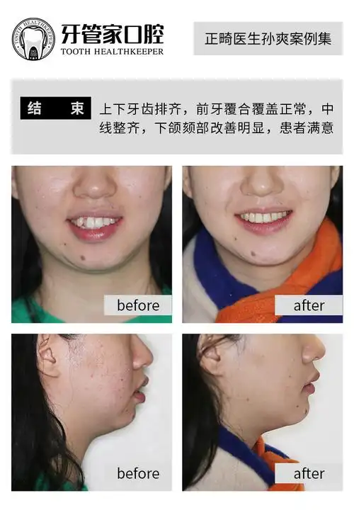 牙齿矫正可以改变脸型么