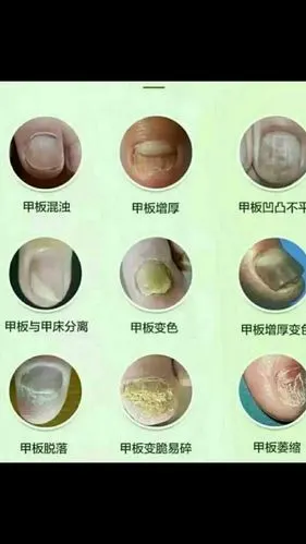 灰指甲患者的福音