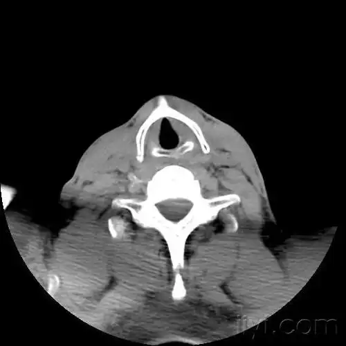 甲状软骨(常见病变,少见部位),请欣赏