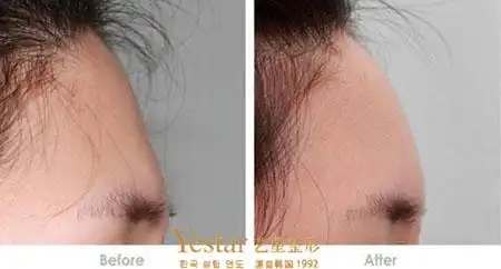 额部填充术的方法是哪种 - 武汉印堂填充_自体脂肪印堂填充_武汉