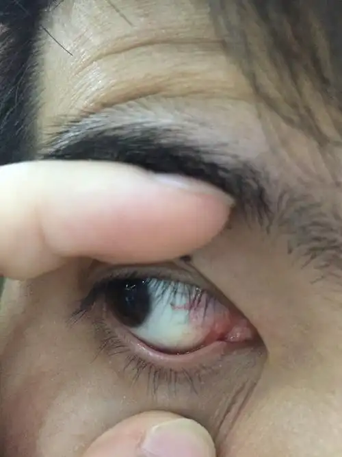 眼白有黄色透明果冻状物_王飞_主治医师_爱问健康