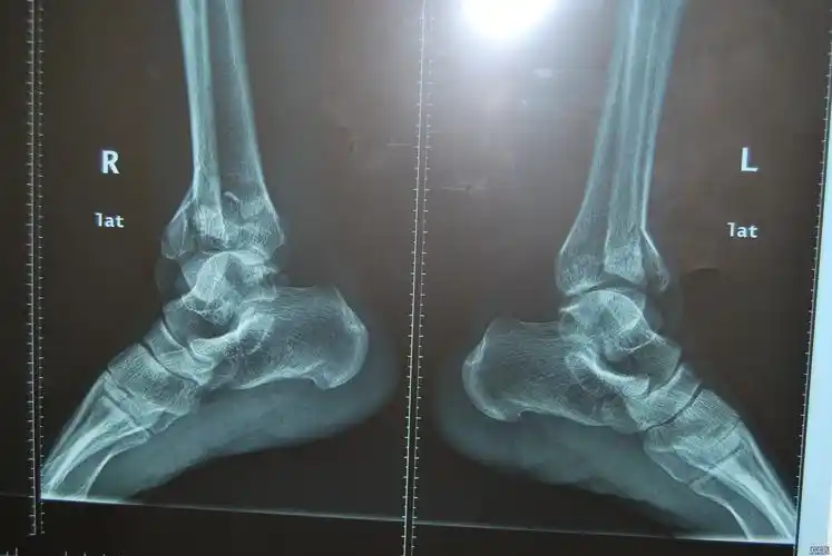 双胫腓骨下段粉碎性骨折求治疗方案